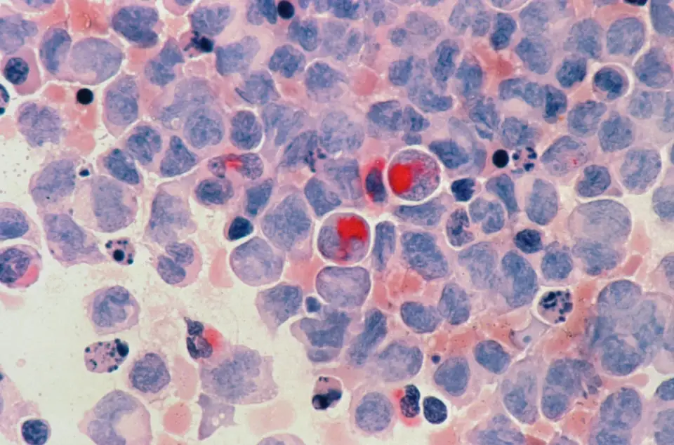 Chinese Researchers Develop AI Diagnostic Tool for Predicting Liver Cancer Recurrence